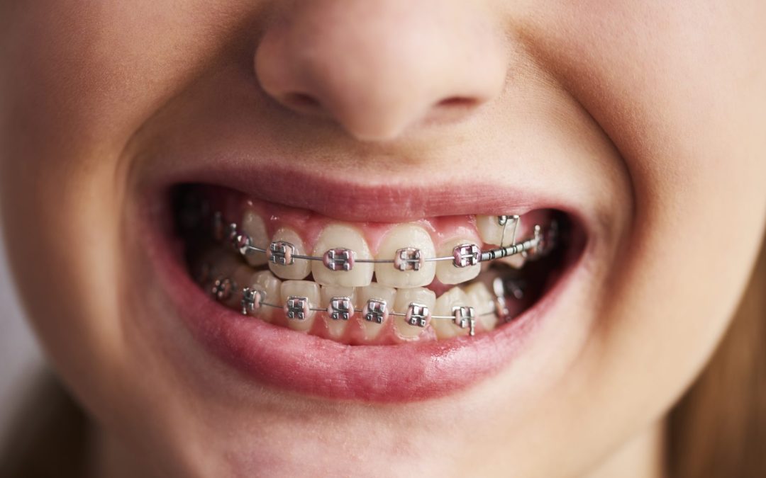 Cuidado de la Ortodoncia